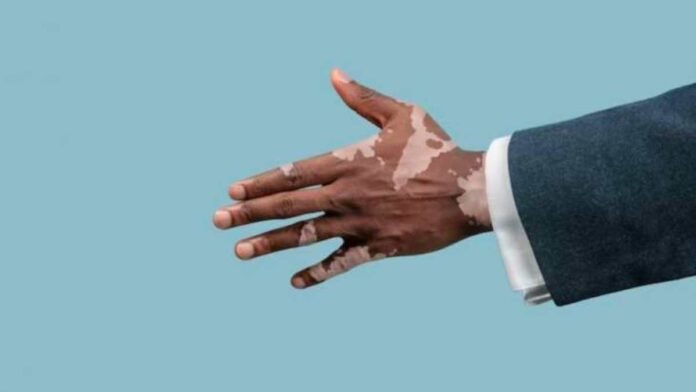 Vitiligo