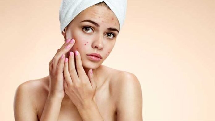 Home Remedies for Acne-Free Skin