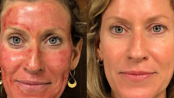 what is vampire facial