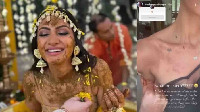 Neelam Upadhyaya Skin Reaction Haldi