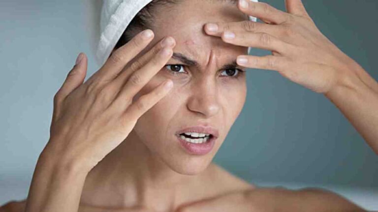 Dermatologists Explain How Stress and Anxiety Cause Breakouts, Hair Loss, and Premature Ageing