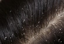 Dandruff Won’t Go Away? A Dermatologist Explains the 3 Types — and Why Most Shampoos Fail Dermatologist examining patient scalp for dandruff diagnosis