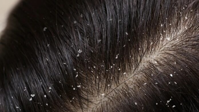 Dermatologist examining patient scalp for dandruff diagnosis