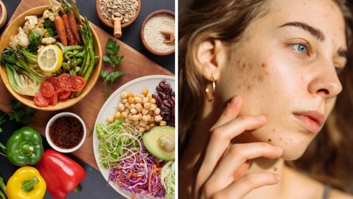Foods that cause acne and foods for clear skin